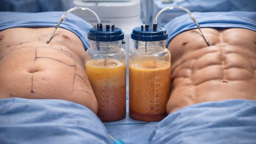 Milton Seigi Hayashi explica que a Lipo HD é indicada para casos específicos e requer planejamento detalhado.