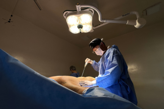 A Lipo HD difere da lipoaspiração tradicional e exige indicação criteriosa, destaca Milton Seigi Hayashi.